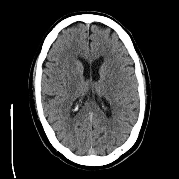 File:Acute A3 occlusion with ACA ischemic penumbra (CT perfusion) (Radiopaedia 72036-82525 Axial non-contrast 26).jpg