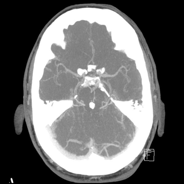 File:Acute A3 occlusion with ACA ischemic penumbra (CT perfusion) (Radiopaedia 72036-82527 Axial 10 sec delay thick MIP 10).jpg