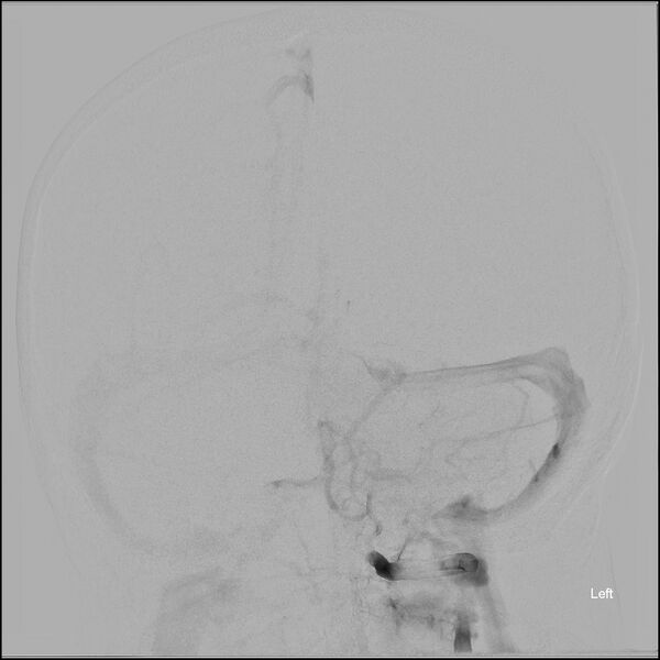 File:Acute P1 occlusion with PCA ischemia penumbra (CT perfusion) (Radiopaedia 72084-82589 Pre ECR frontal - Left VA injection 15).jpg