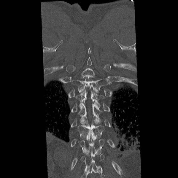 File:Acute and chronic vertebral compression fractures (Radiopaedia 31608-32494 Coronal bone window 41).jpg