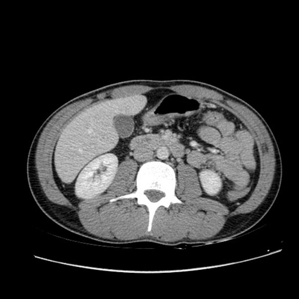 File:Acute appendicitis (Radiopaedia 27049-27227 Axial C+ portal venous phase 33).jpg
