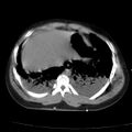 Acute aspiration pneumonitis (Radiopaedia 33605-34703 Axial non-contrast 68).jpg