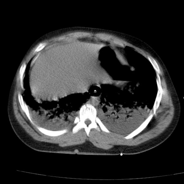 File:Acute aspiration pneumonitis (Radiopaedia 33605-34703 Axial non-contrast 68).jpg