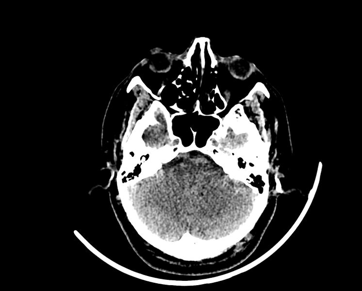 File:Acute cerebral infarct (Radiopaedia 35604-37123 Axial non-contrast 22).jpg