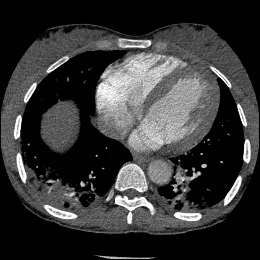 Acute chest syndrome - sickle cell disease (Radiopaedia 42375-45499 Axial C+ CTPA 133).jpg