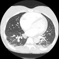Acute chest syndrome - sickle cell disease (Radiopaedia 42375-45499 Axial lung window 116).jpg