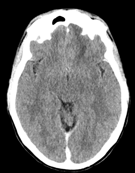 File:Acute disseminated encephalomyelitis (ADEM) (Radiopaedia 65319-74348 Axial C+ delayed 14).png