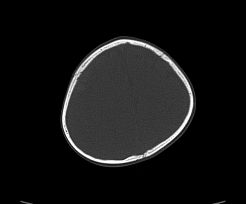 Acute hemorrhagic contusion (Radiopaedia 63660-72336 Axial bone window 54).jpg