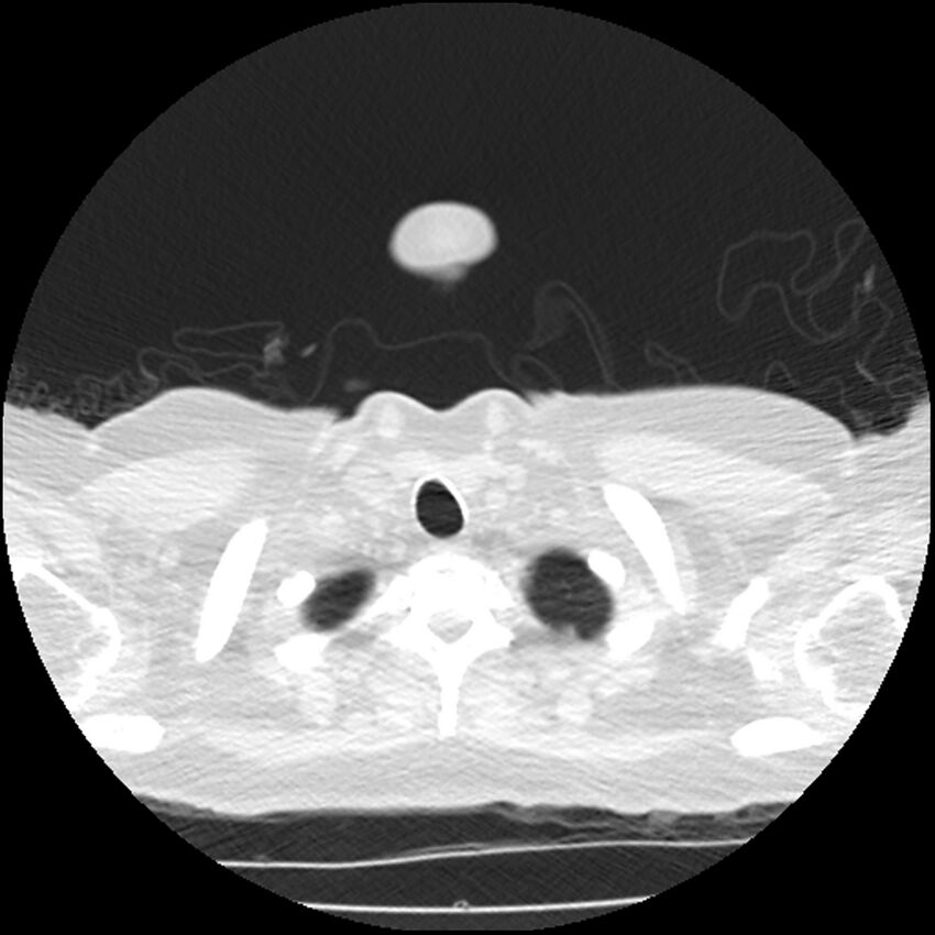 Acute interstitial pneumonitis (Radiopaedia 45404-49444 Axial lung window 4).jpg