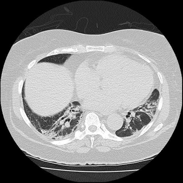 File:Acute interstitial pneumonitis (Radiopaedia 45404-49452 Axial lung window 61).jpg