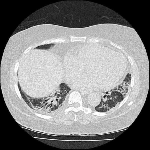 File:Acute interstitial pneumonitis (Radiopaedia 45404-49452 Axial lung window 63).jpg