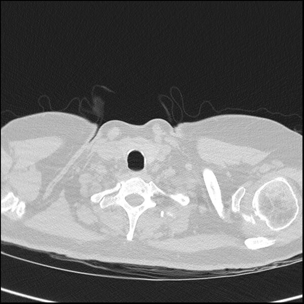 File:Acute interstitial pneumonitis (Radiopaedia 45404-49453 Axial lung window 1).jpg