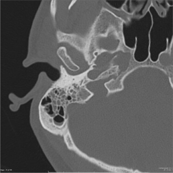 File:Acute otomastoiditis (Radiopaedia 28276-28512 Axial PTB bone window reformat 54).jpg