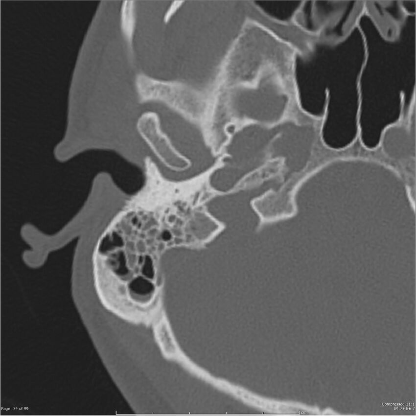 Acute otomastoiditis (Radiopaedia 28276-28512 Axial PTB bone window reformat 54).jpg