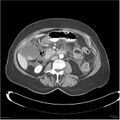 Acute pancreatitis (Radiopaedia 19136-19117 Axial C+ portal venous phase 20).jpg