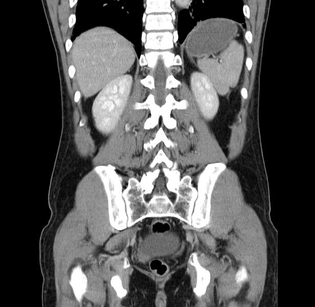 File:Acute pancreatitis (Radiopaedia 22572-22596 Coronal C+ portal venous phase 41).jpg