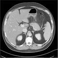 Acute pancreatitis - mild (Radiopaedia 27796-28033 C+ portal venous phase 6).jpg