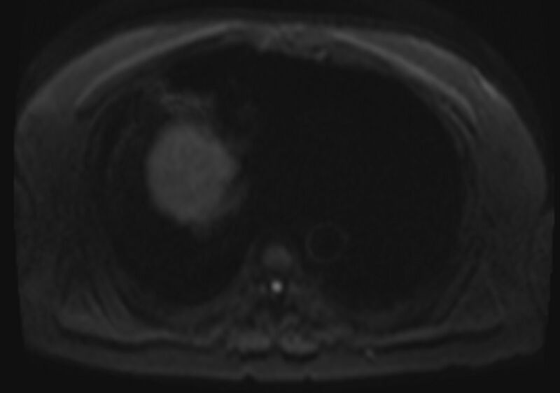 File:Acute portal vein thrombosis (Radiopaedia 73198-83925 Axial DWI 35).jpg