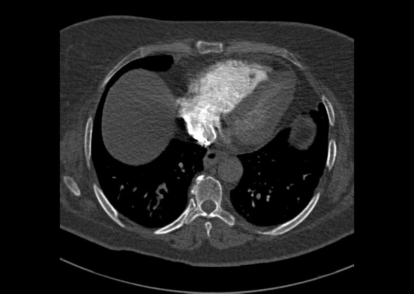 Acute pulmonary embolism (Radiopaedia 29938-30466 Axial C+ CTPA 162).jpg