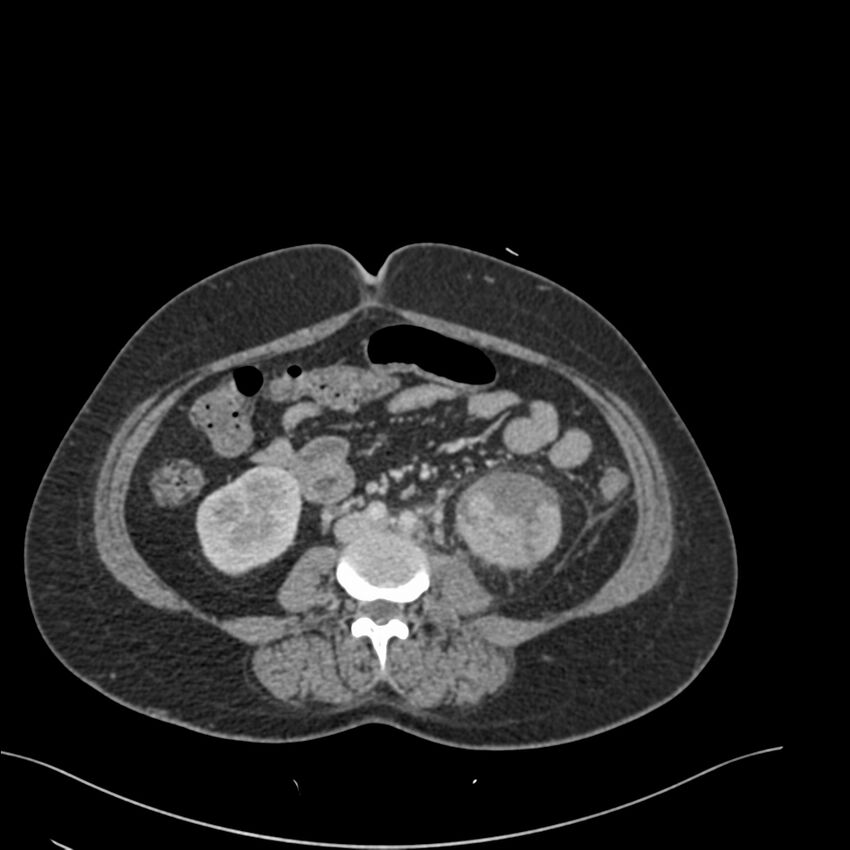 Acute pyelonephritis with renal vein thrombosis (Radiopaedia 58020-65053 Axial renal parenchymal phase 115).jpg