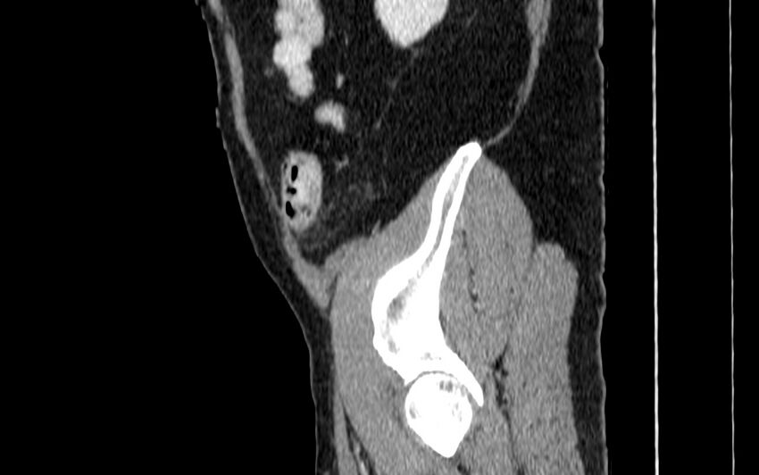Acute sigmoid colon diverticulitis (Radiopaedia 55507-61976 Sagittal C+ portal venous phase 114).jpg