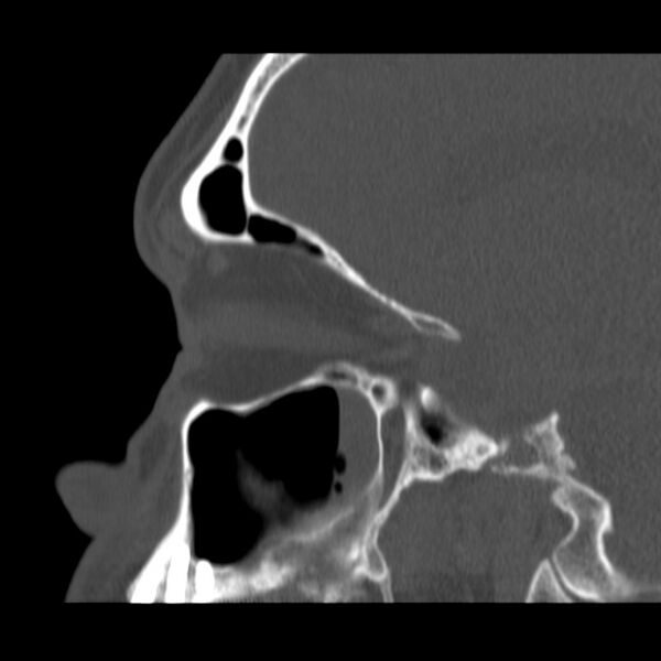 File:Acute sinusitis (Radiopaedia 23161-23215 Sagittal bone window 42).jpg