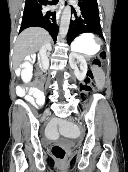 File:Acute small bowel (ileal) volvulus (Radiopaedia 71740-82139 Coronal C+ portal venous phase 74).jpg
