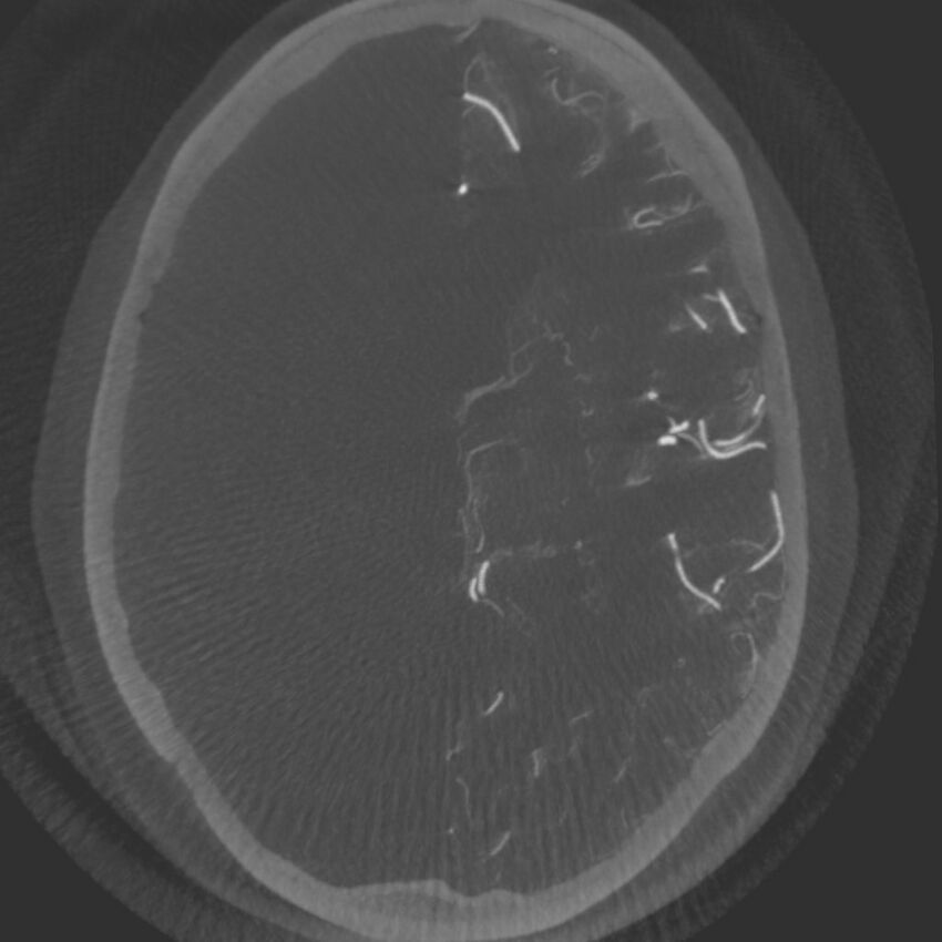 Acute subarachnoid hemorrhage and accessory anterior cerebral artery (Radiopaedia 69231-79010 C 39).jpg