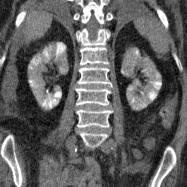 File:Acute tubular necrosis (Radiopaedia 28077-28334 C 20).jpg
