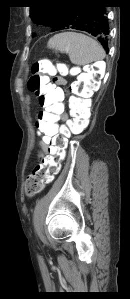 File:Adenocarcinoma of cecum (Radiopaedia 59222-66549 Sagittal C+ portal venous phase 10).jpg