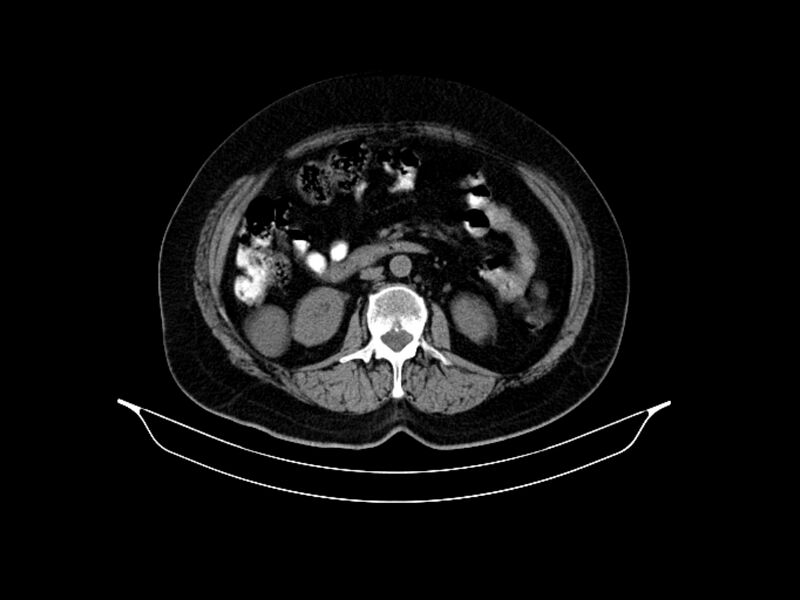 File:Adenocarcinoma of pancreas with hepatic metastasis (Radiopaedia 64332-73122 Axial non-contrast 50).jpg