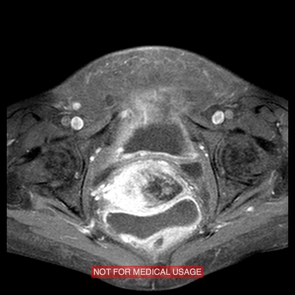 File:Adenocarcinoma of the cervix (Radiopaedia 28373-28615 Axial T1 C+ fat sat 6).jpg