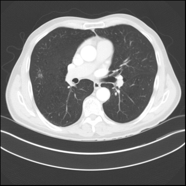 File:Adenocarcinoma of the lung - micropapillary predominant (Radiopaedia 42446-45563 Axial lung window 21).jpg