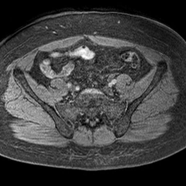 File:Adenomyoma of the uterus (Radiopaedia 9871-10439 Axial T1 fat sat 16).jpg