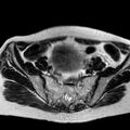 Adenomyoma of the uterus (huge) (Radiopaedia 9870-10438 Axial T2 31).jpg