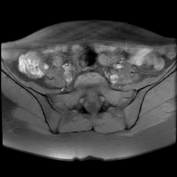 File:Adenomyosis within a septate uterus (Radiopaedia 69963-79981 Axial T1 fat sat 6).jpg