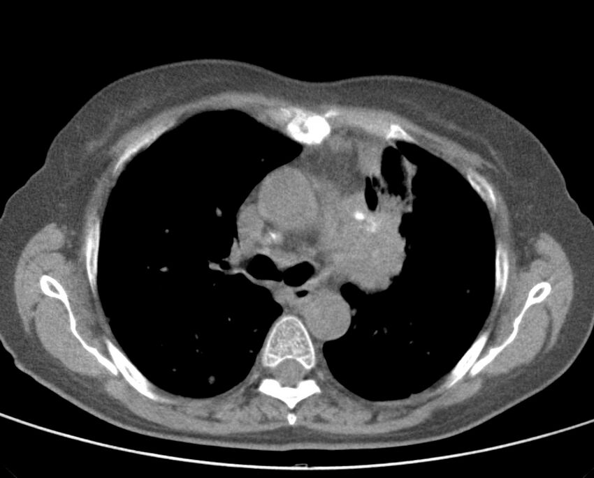 Adenosquamous lung carcinoma (Radiopaedia 22035-22030 non-contrast 27).jpg