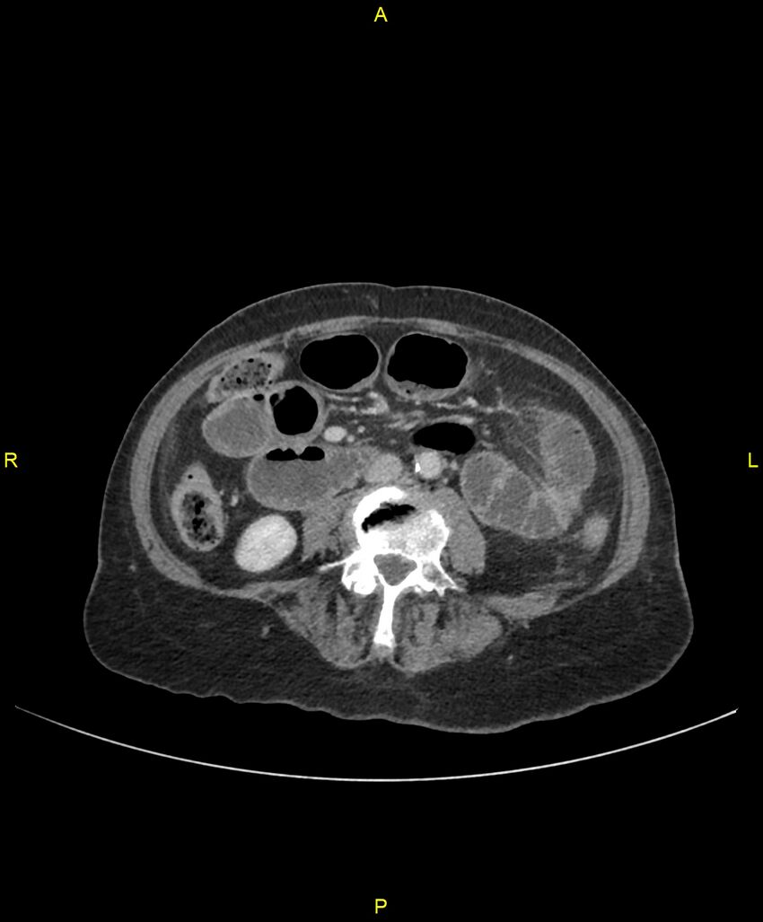 Adhesional small bowel obstruction (Radiopaedia 85402-101024 Axial C+ portal venous phase 154).jpg