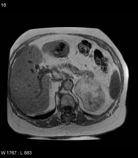 File:Adrenal myelolipoma (Radiopaedia 6765-7961 Axial T1 in-phase 16).jpg