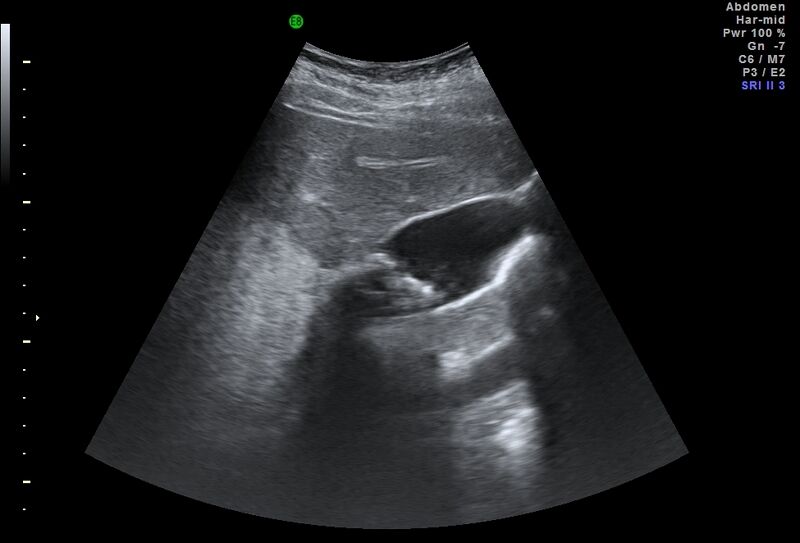 File:Adrenal myelolipoma - bilateral (Radiopaedia 74805-85811 Abdominal ultrasound 6).jpg