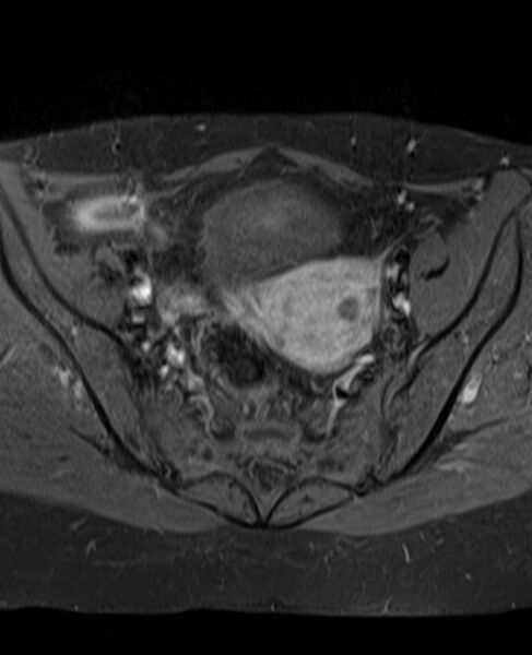File:Adult granulosa cell tumor of the ovary (Radiopaedia 71581-81950 Axial T1 C+ fat sat 12).jpg