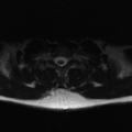 Aggressive vertebral hemangioma (Radiopaedia 39937-42404 Axial T2 40).png