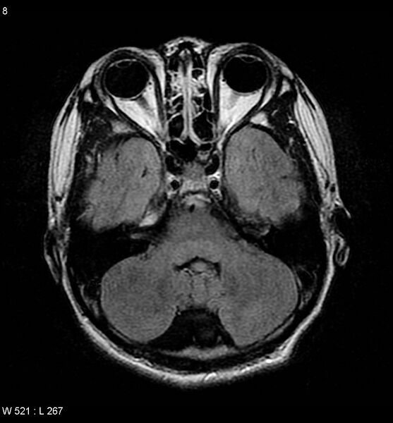 File:Aicardi syndrome (Radiopaedia 5353-7117 Axial FLAIR 3).jpg