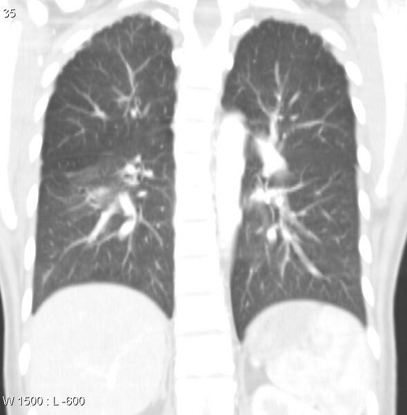 File:Air crescent sign (aspergilloma) (Radiopaedia 14380-14306 Coronal lung window 2).jpg