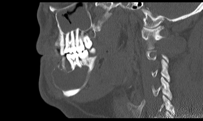 File:Ameloblastoma (Radiopaedia 33677-34806 Sagittal bone window 25).png