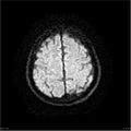 Amnestic syndrome secondary to hypoxic brain injury (Radiopaedia 24743-25004 DWI 25).jpg