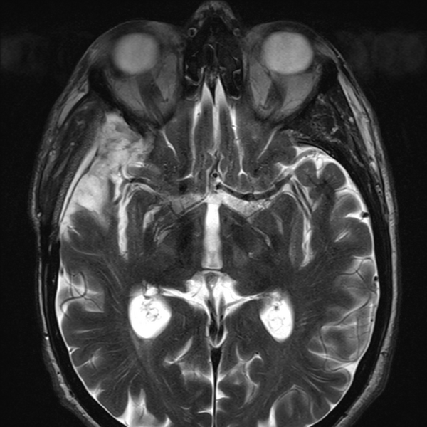 File:Anaplastic meningioma with recurrence (Radiopaedia 34452-35788 Axial T2 10).png