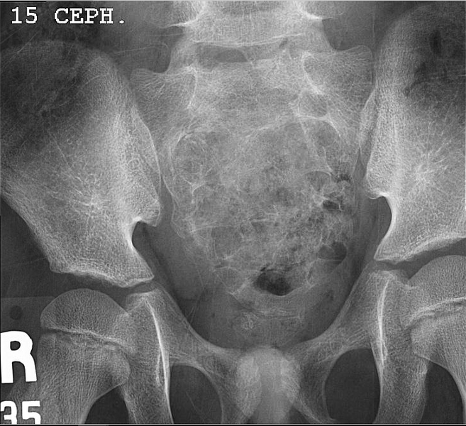File:Aneurysmal bone cyst - sacrum (Radiopaedia 65190-74208 A 1).png