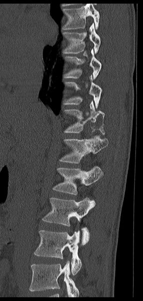 File:Aneurysmal bone cyst T11 (Radiopaedia 29294-29721 Sagittal bone window 50).jpg