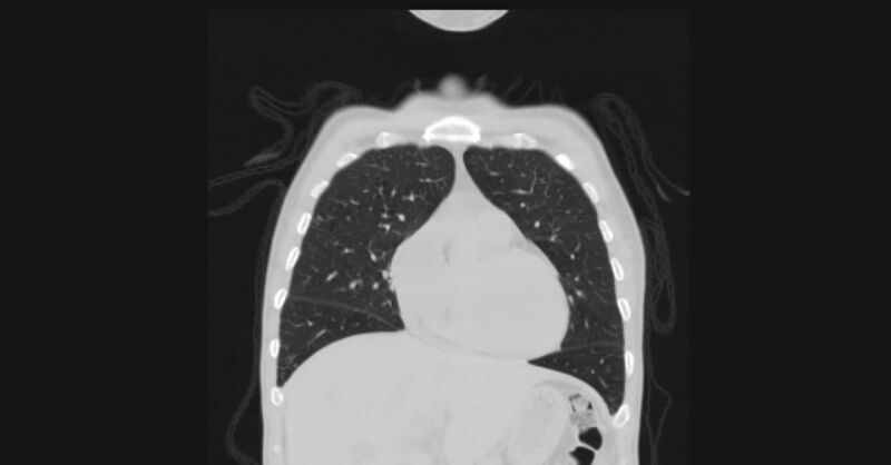 File:Angioinvasive aspergellosis (Radiopaedia 66995-76315 Coronal lung window 17).jpg